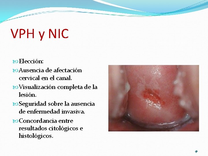 VPH y NIC Elección: Ausencia de afectación cervical en el canal. Visualización completa de VPH y NIC Elección: Ausencia de afectación cervical en el canal. Visualización completa de