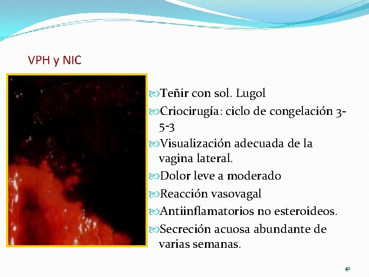 VPH y NIC Teñir con sol. Lugol Criocirugía: ciclo de congelación 35 -3 Visualización VPH y NIC Teñir con sol. Lugol Criocirugía: ciclo de congelación 35 -3 Visualización