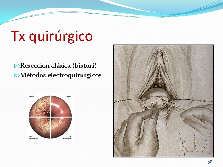 Tx quirúrgico Resección clásica (bisturí) Métodos electroquirúrgicos 58 Tx quirúrgico Resección clásica (bisturí) Métodos electroquirúrgicos 58