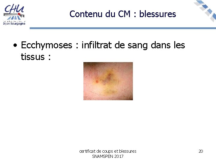 Contenu du CM : blessures • Ecchymoses : infiltrat de sang dans les tissus