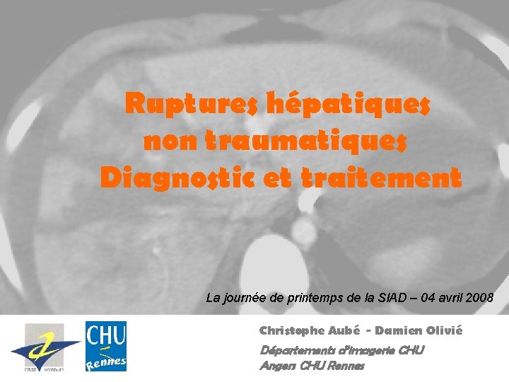 Ruptures hépatiques non traumatiques Diagnostic et traitement La journée de printemps de la SIAD