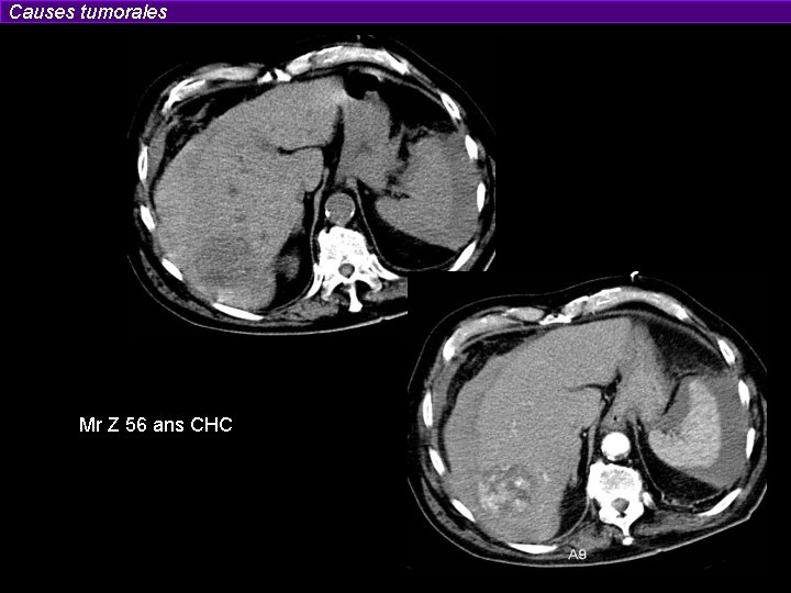 Causes tumorales Mr Z 56 ans CHC 