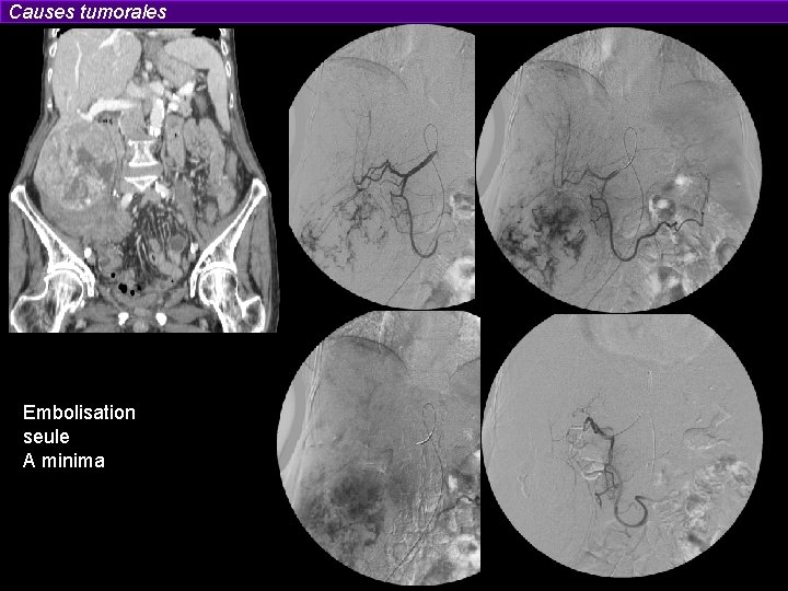 Causes tumorales Embolisation seule A minima 