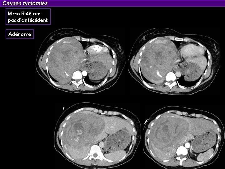 Causes tumorales Mme R 46 ans pas d’antécédent Adénome 