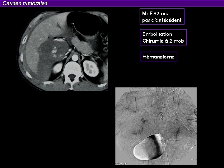 Causes tumorales Mr F 32 ans pas d’antécédent Embolisation Chirurgie à 2 mois Hémangiome