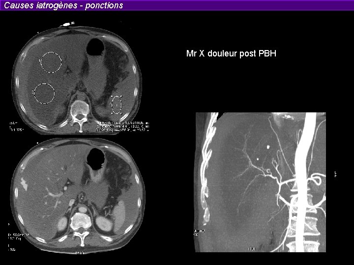 Causes iatrogènes - ponctions Mr X douleur post PBH 