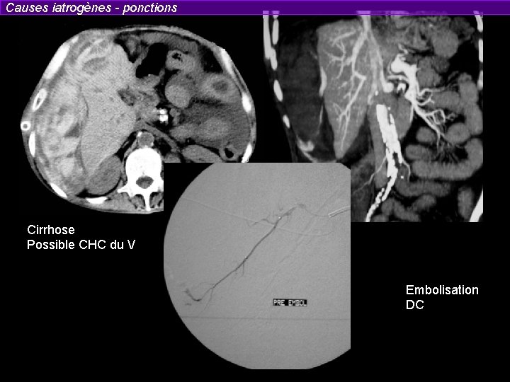 Causes iatrogènes - ponctions Cirrhose Possible CHC du V Embolisation DC 