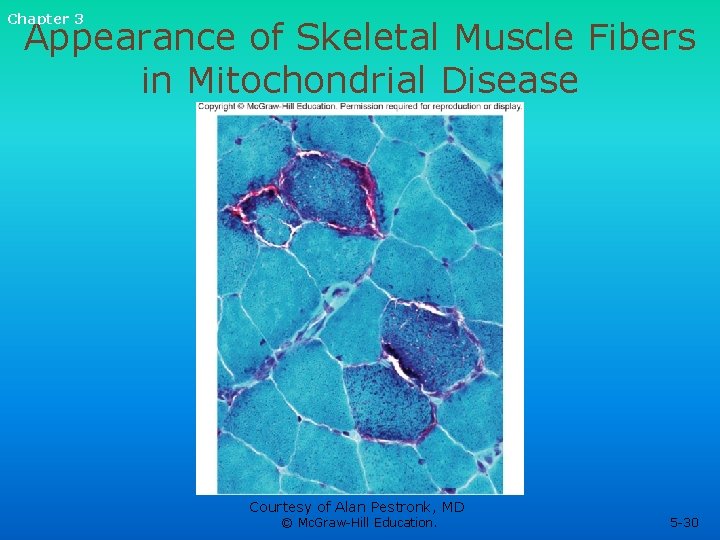 Chapter 3 Appearance of Skeletal Muscle Fibers in Mitochondrial Disease Courtesy of Alan Pestronk, Chapter 3 Appearance of Skeletal Muscle Fibers in Mitochondrial Disease Courtesy of Alan Pestronk,