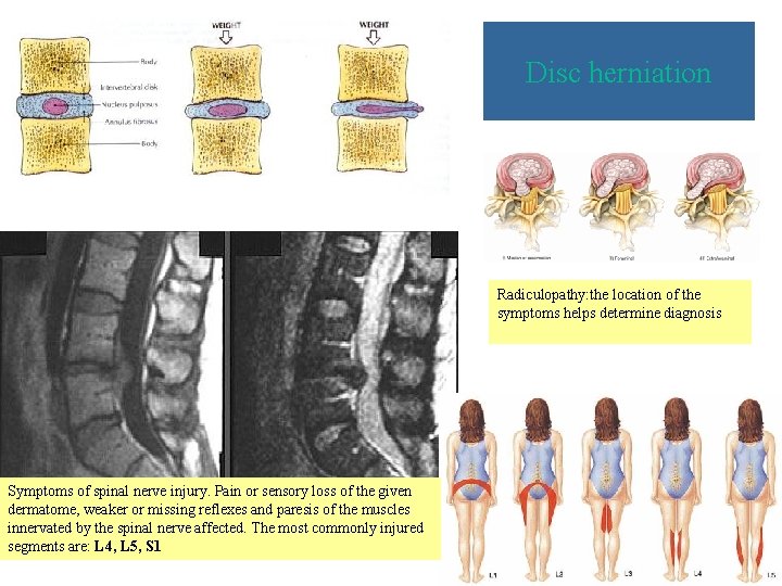 Disc herniation Radiculopathy: the location of the symptoms helps determine diagnosis Symptoms of spinal