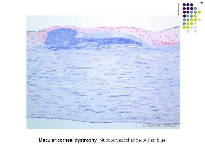 15 Macular corneal dystrophy: Mucopolysaccharide: Alcian blue 