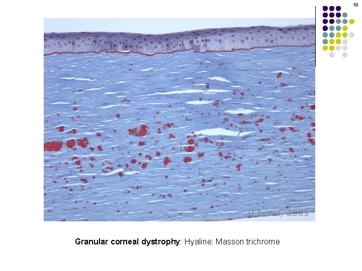 18 Granular corneal dystrophy: Hyaline: Masson trichrome 