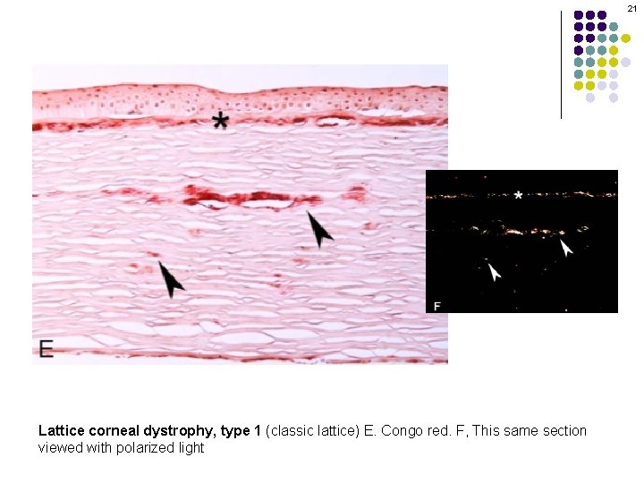 21 Lattice corneal dystrophy, type 1 (classic lattice) E. Congo red. F, This same