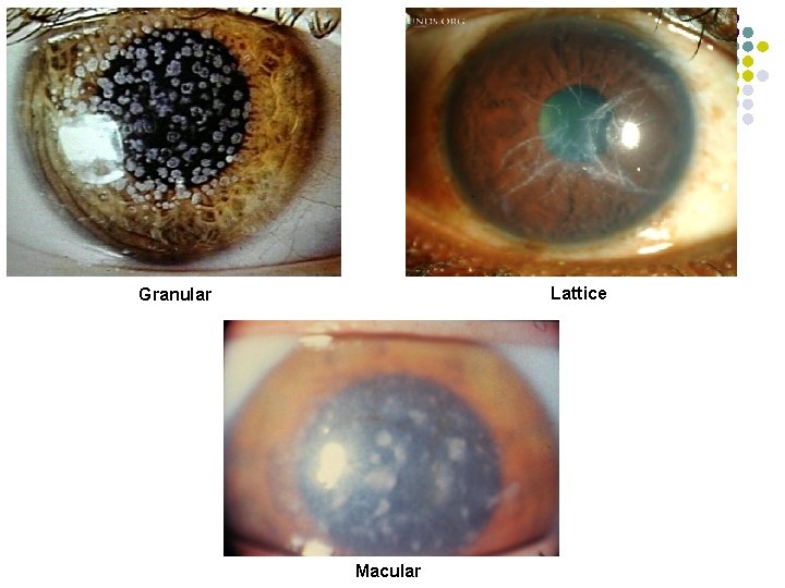 Lattice Granular Macular 