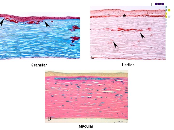 Lattice Granular Macular 