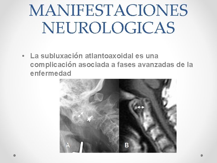 MANIFESTACIONES NEUROLOGICAS • La subluxación atlantoaxoidal es una complicación asociada a fases avanzadas de