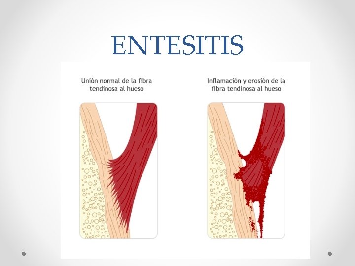 ENTESITIS 