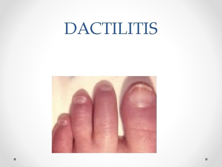 DACTILITIS 