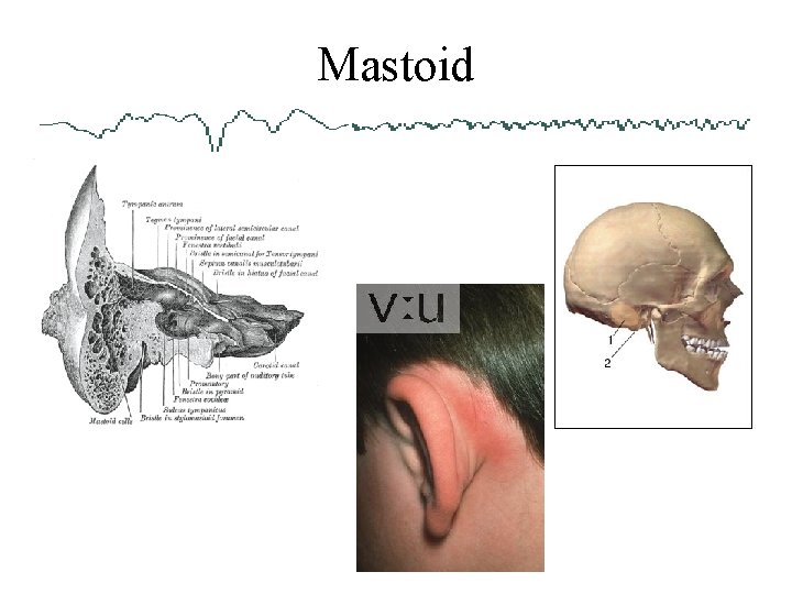 Mastoid 