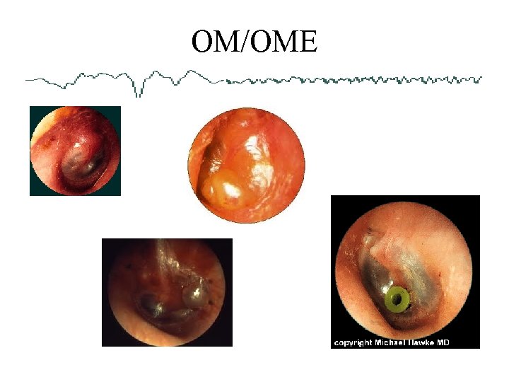 OM/OME 