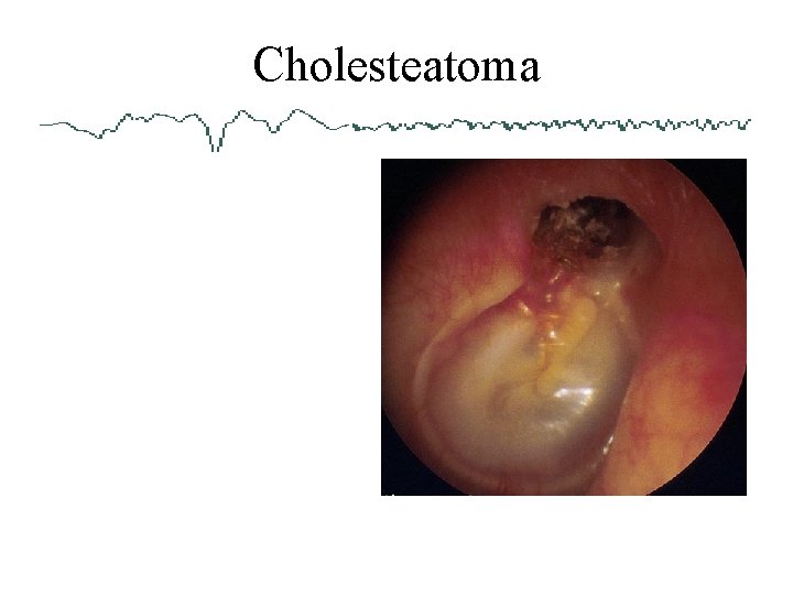 Cholesteatoma 