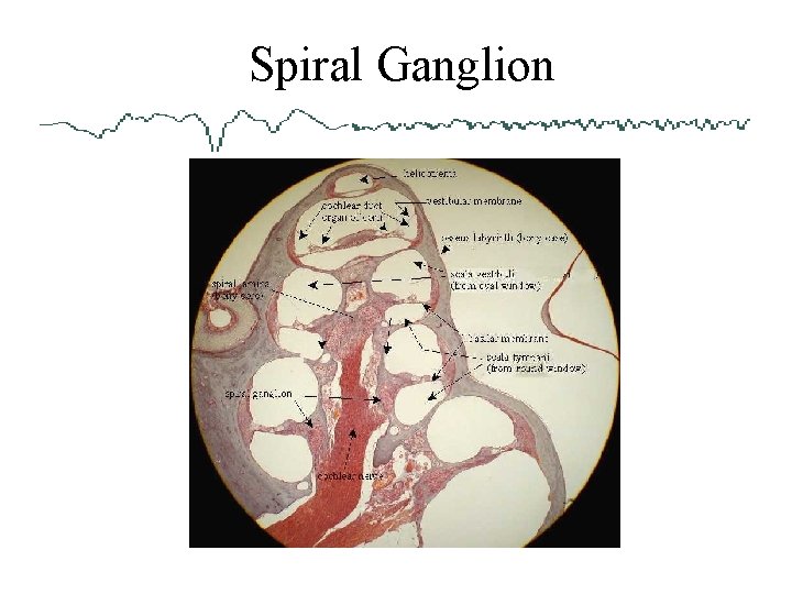  Spiral Ganglion 