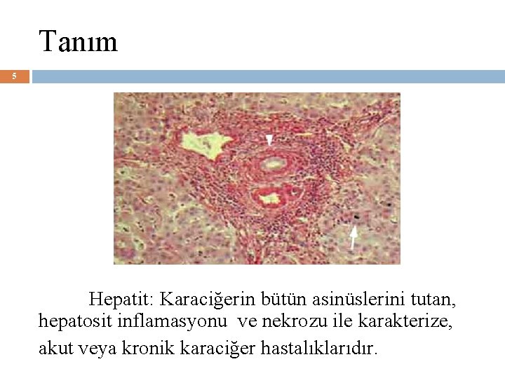 Tanım 5 Hepatit: Karaciğerin bütün asinüslerini tutan, hepatosit inflamasyonu ve nekrozu ile karakterize, akut