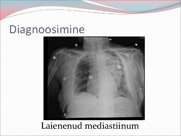 Diagnoosimine Laienenud mediastiinum 