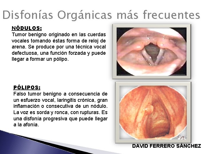 Disfonías Orgánicas más frecuentes NÓDULOS: Tumor benigno originado en las cuerdas vocales tomando éstas