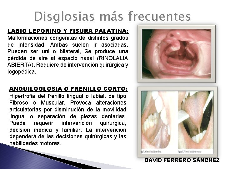 Disglosias más frecuentes LABIO LEPORINO Y FISURA PALATINA: Malformaciones congénitas de distintos grados de