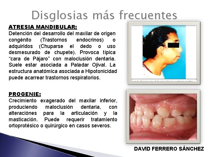 Disglosias más frecuentes ATRESIA MANDIBULAR: Detención del desarrollo del maxilar de origen congénito (Trastornos