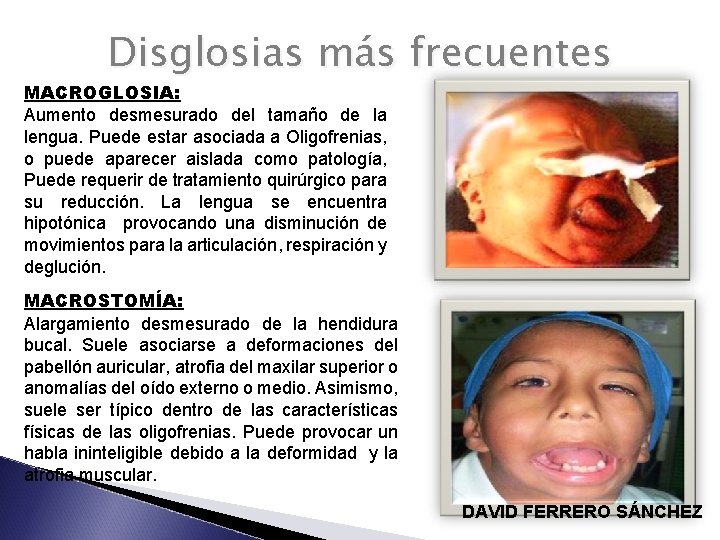 Disglosias más frecuentes MACROGLOSIA: Aumento desmesurado del tamaño de la lengua. Puede estar asociada