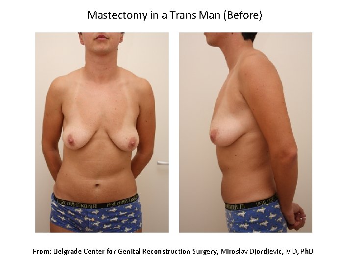 Mastectomy in a Trans Man (Before) From: Belgrade Center for Genital Reconstruction Surgery, Miroslav