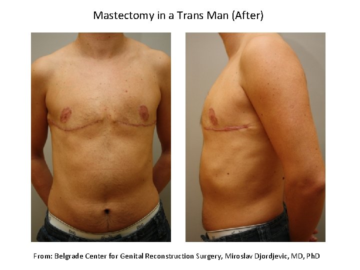 Mastectomy in a Trans Man (After) From: Belgrade Center for Genital Reconstruction Surgery, Miroslav