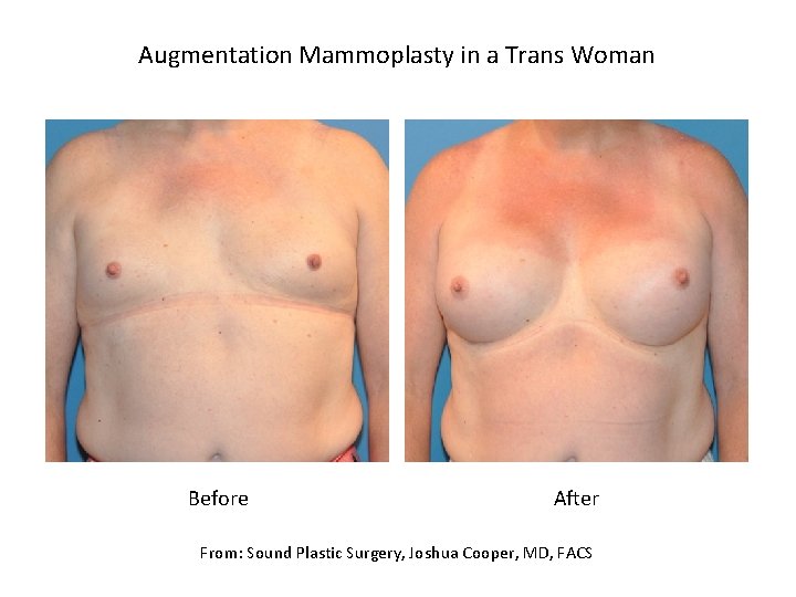 Augmentation Mammoplasty in a Trans Woman Before After From: Sound Plastic Surgery, Joshua Cooper,