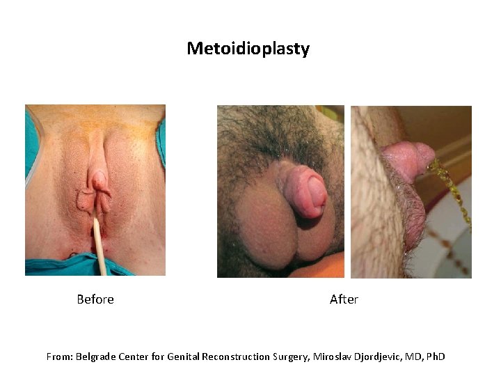 Metoidioplasty Before After From: Belgrade Center for Genital Reconstruction Surgery, Miroslav Djordjevic, MD, Ph.