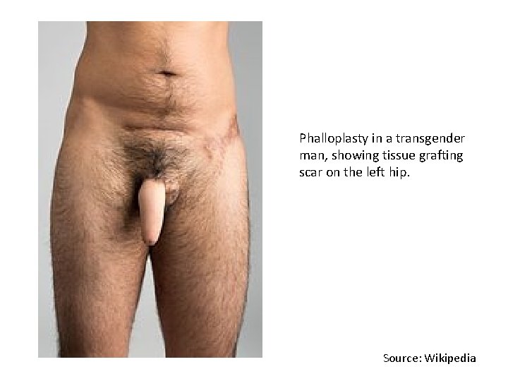 Phalloplasty in a transgender man, showing tissue grafting scar on the left hip. Source: