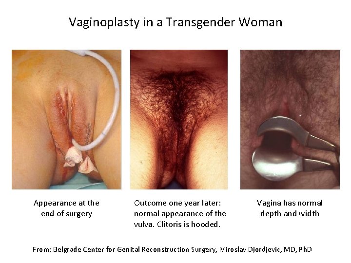 Vaginoplasty in a Transgender Woman Appearance at the end of surgery Outcome one year