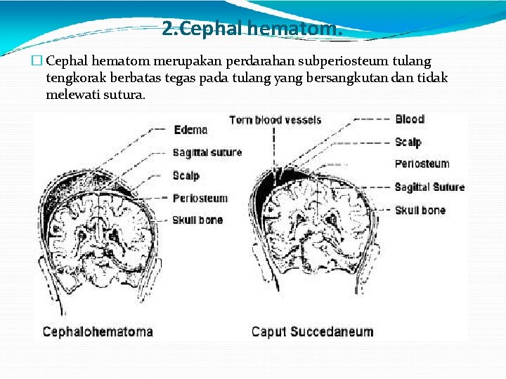 2. Cephal hematom. � Cephal hematom merupakan perdarahan subperiosteum tulang tengkorak berbatas tegas pada