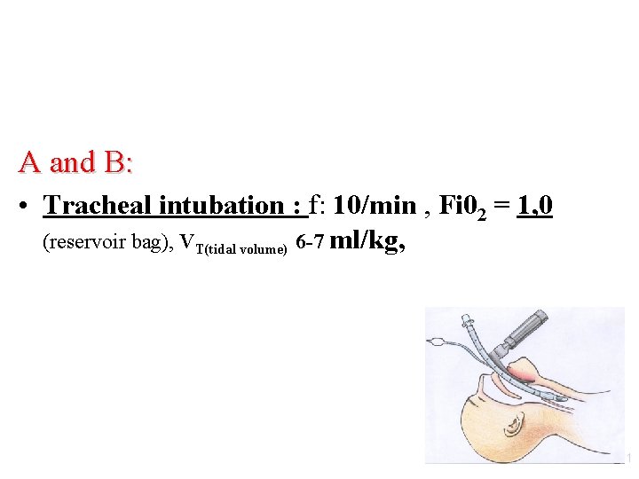 A and B: • Tracheal intubation : f: 10/min , Fi 02 = 1,