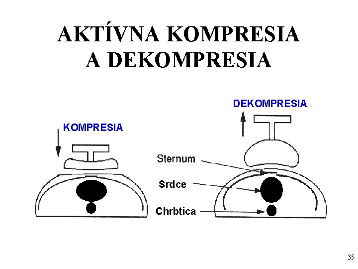 AKTÍVNA KOMPRESIA A DEKOMPRESIA Srdce Chrbtica 35 