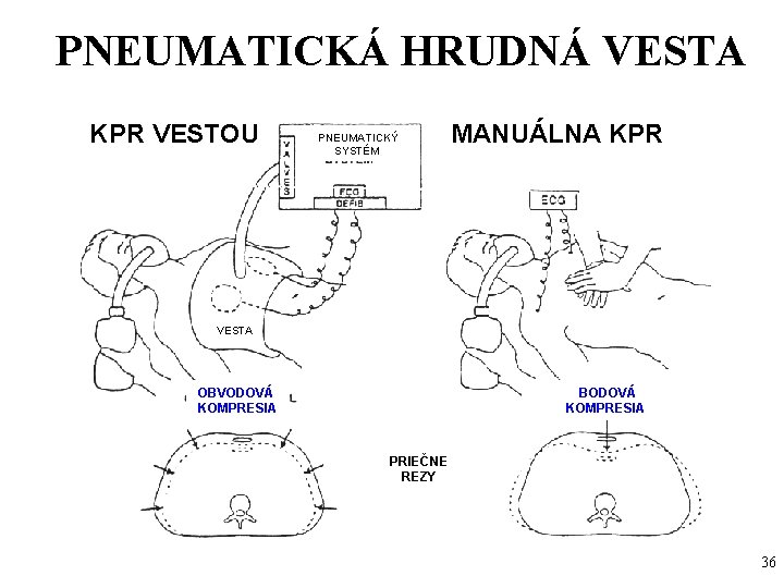 PNEUMATICKÁ HRUDNÁ VESTA KPR VESTOU PNEUMATICKÝ SYSTÉM MANUÁLNA KPR VESTA OBVODOVÁ KOMPRESIA BODOVÁ KOMPRESIA