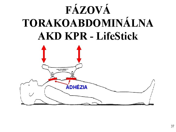 FÁZOVÁ TORAKOABDOMINÁLNA AKD KPR - Life. Stick ADHÉZIA 37 