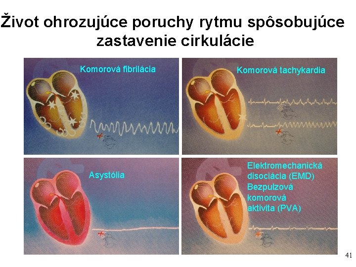 Život ohrozujúce poruchy rytmu spôsobujúce zastavenie cirkulácie Komorová fibrilácia Asystólia Komorová tachykardia Elektromechanická disociácia