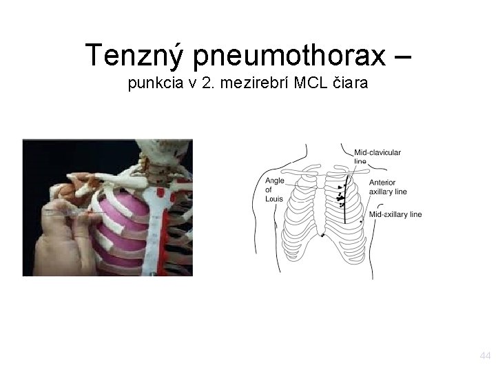 Tenzný pneumothorax – punkcia v 2. mezirebrí MCL čiara 44 Tenzný pneumothorax – punkcia v 2. mezirebrí MCL čiara 44
