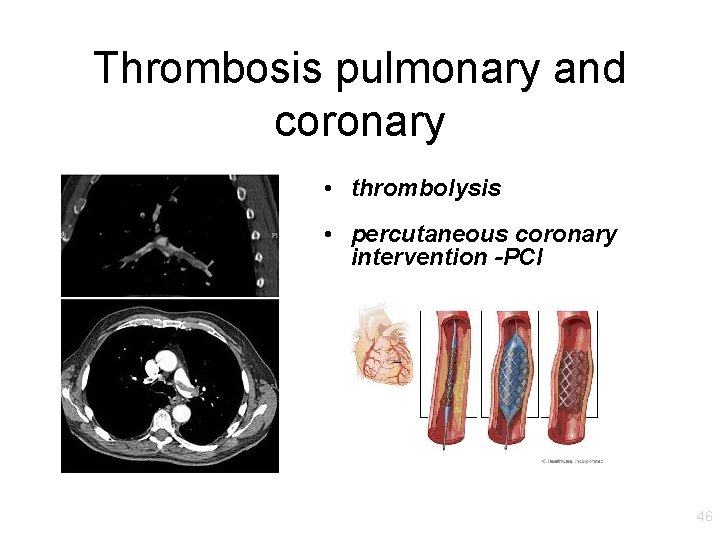 Thrombosis pulmonary and coronary • thrombolysis • percutaneous coronary intervention -PCI 46 