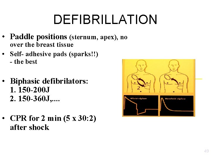 DEFIBRILLATION • Paddle positions (sternum, apex), no over the breast tissue • Self- adhesive DEFIBRILLATION • Paddle positions (sternum, apex), no over the breast tissue • Self- adhesive