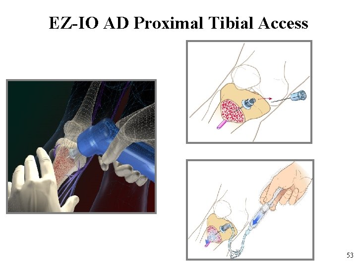 EZ-IO AD Proximal Tibial Access Intraosseous Infusion System 53 