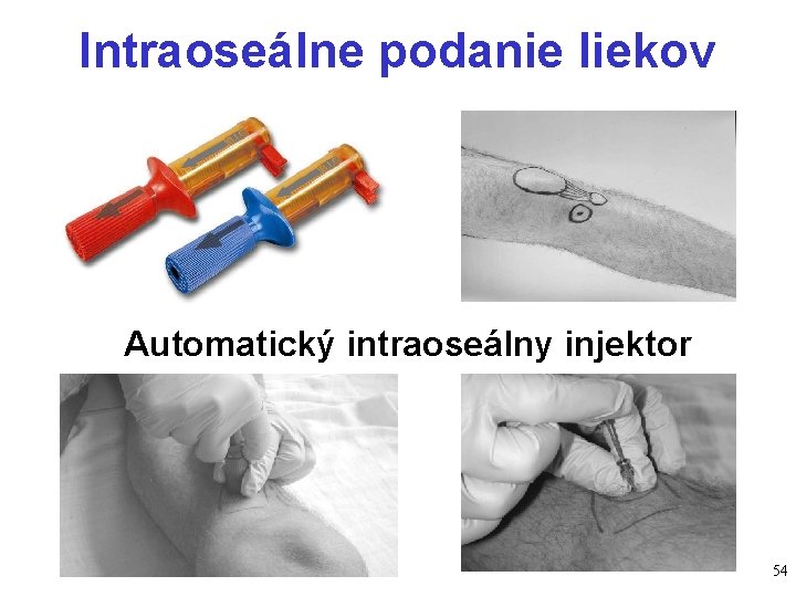 Intraoseálne podanie liekov Automatický intraoseálny injektor 54 