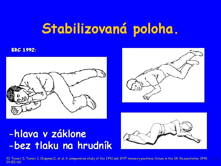 Stabilizovaná poloha. ERC 1992: -hlava v záklone -bez tlaku na hrudník 93. Turner S, Stabilizovaná poloha. ERC 1992: -hlava v záklone -bez tlaku na hrudník 93. Turner S,