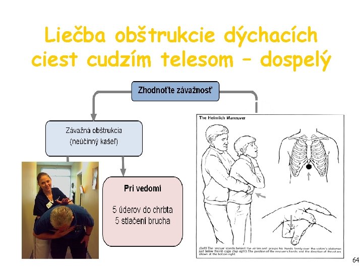 Liečba obštrukcie dýchacích ciest cudzím telesom – dospelý 64 Liečba obštrukcie dýchacích ciest cudzím telesom – dospelý 64